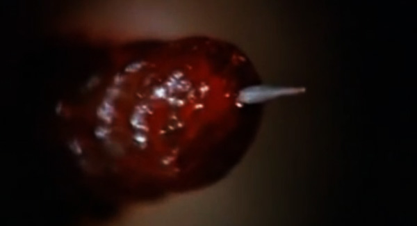 Sometimes a parasitical stinger is just a parasitical stinger